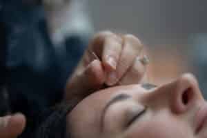 Acupuncture treatment may boost your immune system. Studies show