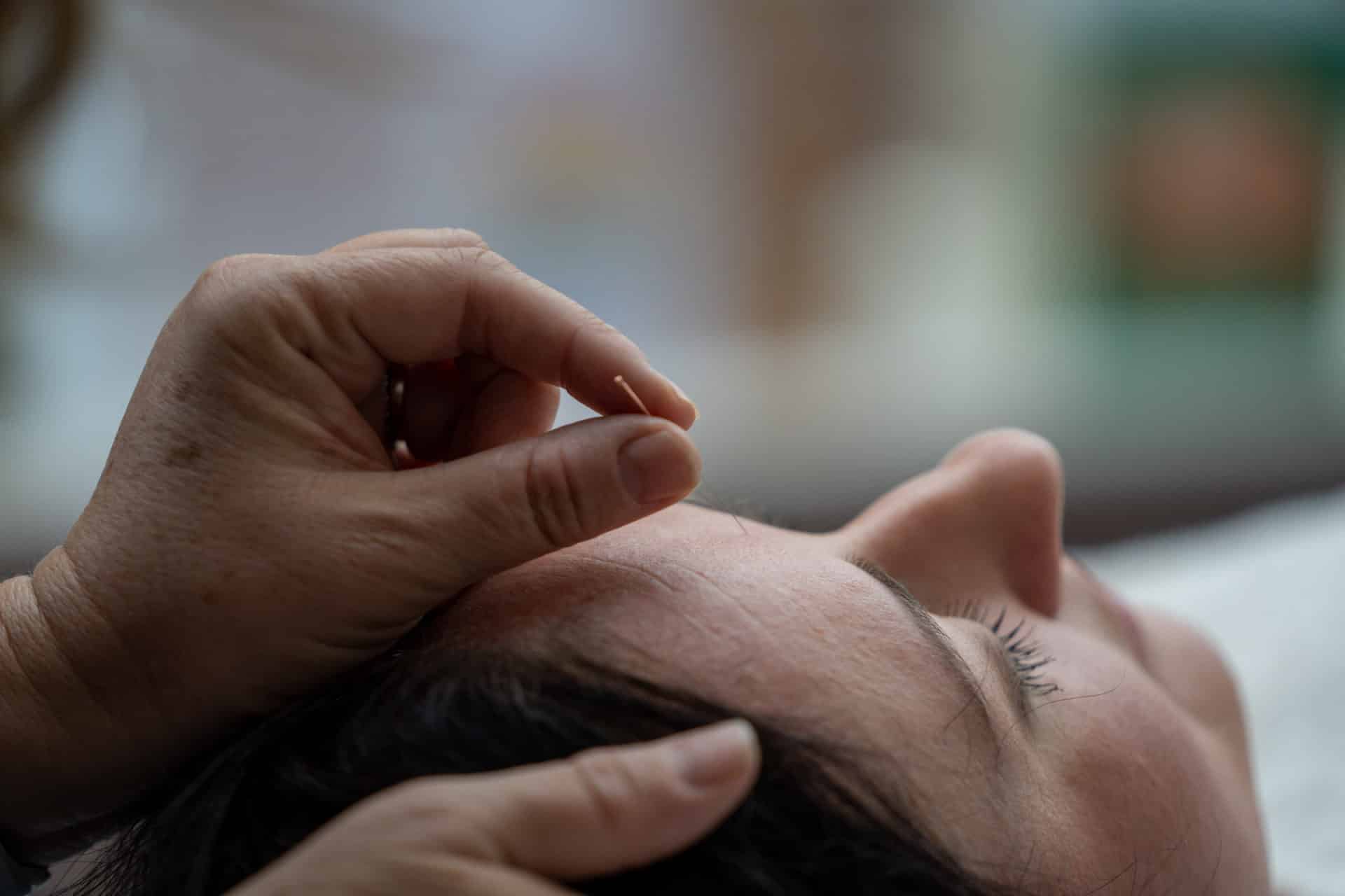 Acupuncture treatment for Hayfever, allergies and blocked sinuses